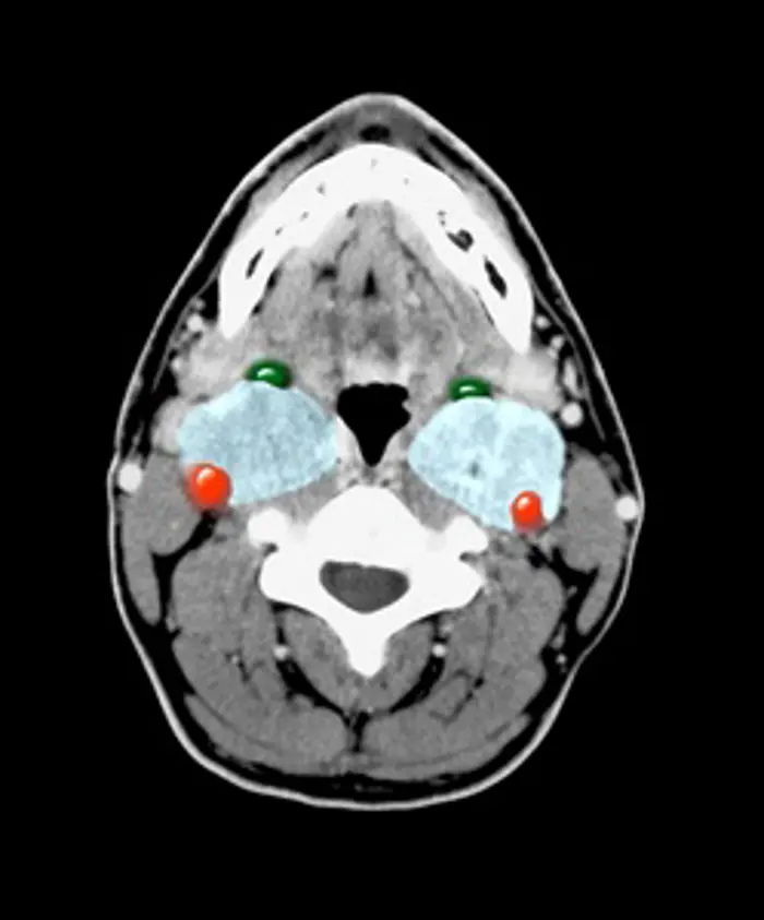Paraganglioma research